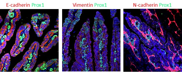  Transformed epithelial cells (Prox1+ cells  stained in  green) are taking the first steps of invasion and metastasis in the epi